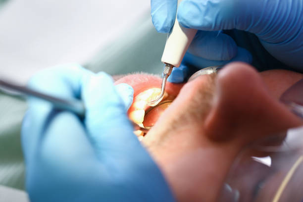 Best Emergency Tooth Extraction in Sylvan Springs, AL